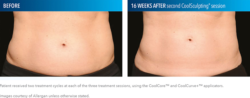 CoolSculpting Results Tampa