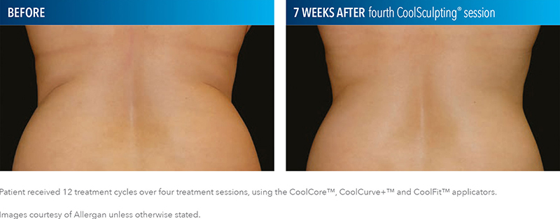 CoolSculpting Results Tampa
