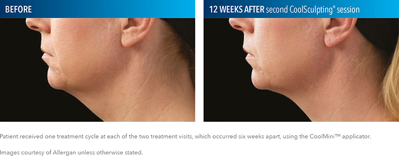 CoolSculpting Results Tampa