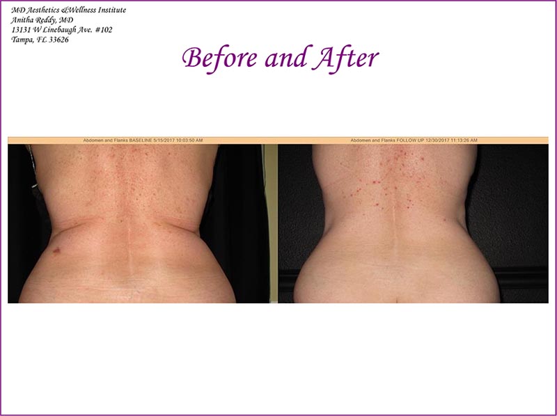 Coolsculpting Before and After Treatment Photo 1