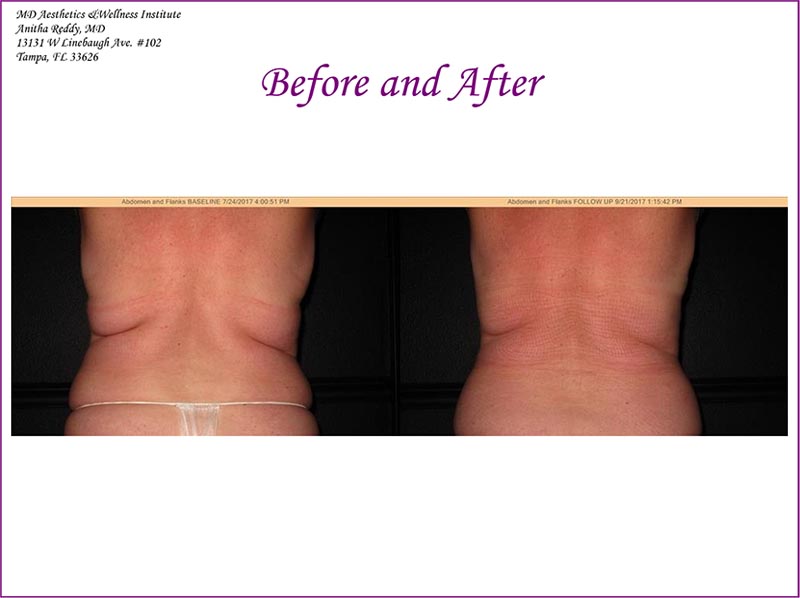 Coolsculpting Before and After Treatment Photo 2
