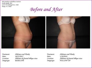 CoolSculpting Before and After