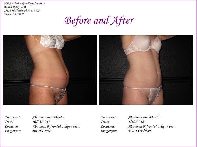 Coolsculpting Before and After Treatment Photo 3