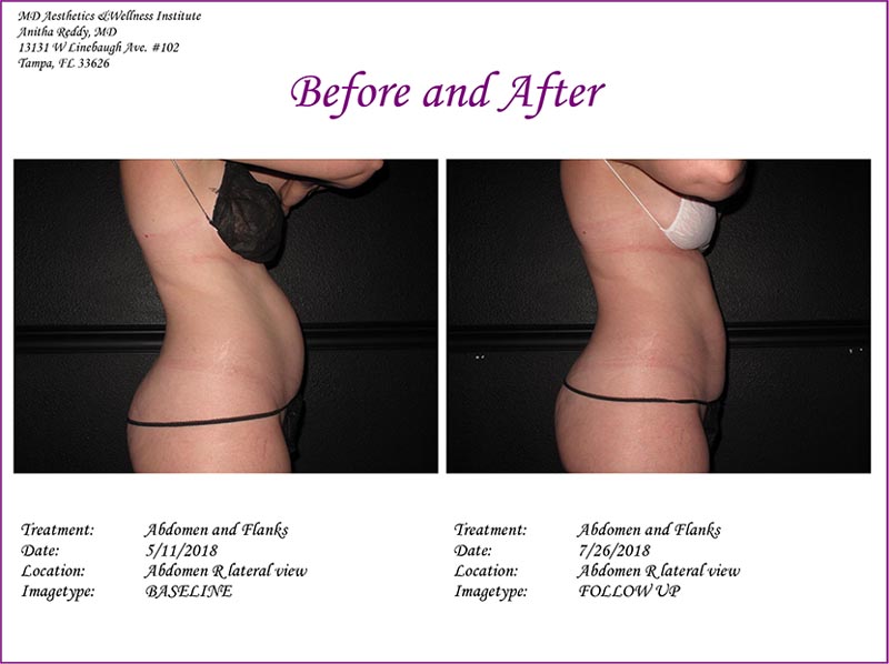 Coolsculpting Before and After Treatment Photo 4