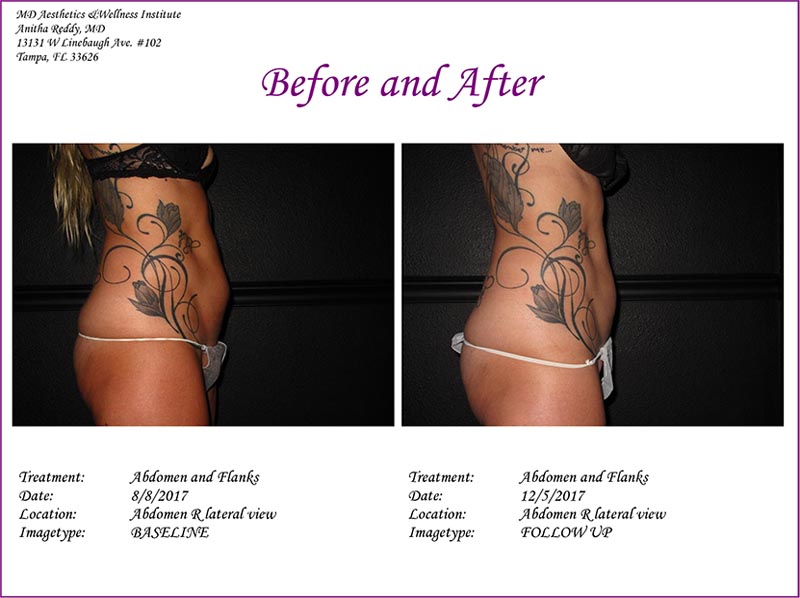 Coolsculpting Before and After Treatment Photo 5