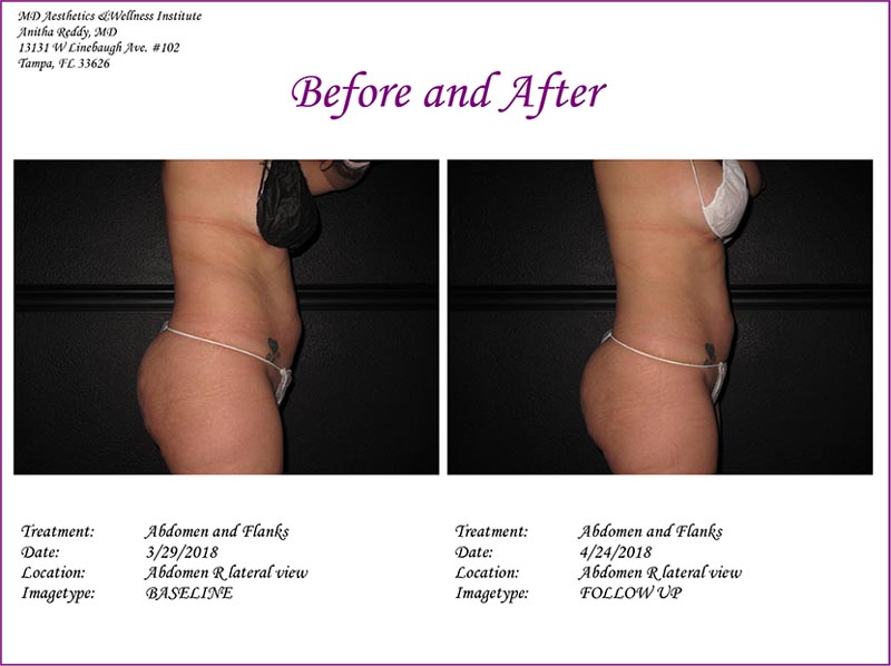 Coolsculpting Before and After Treatment Photo 6