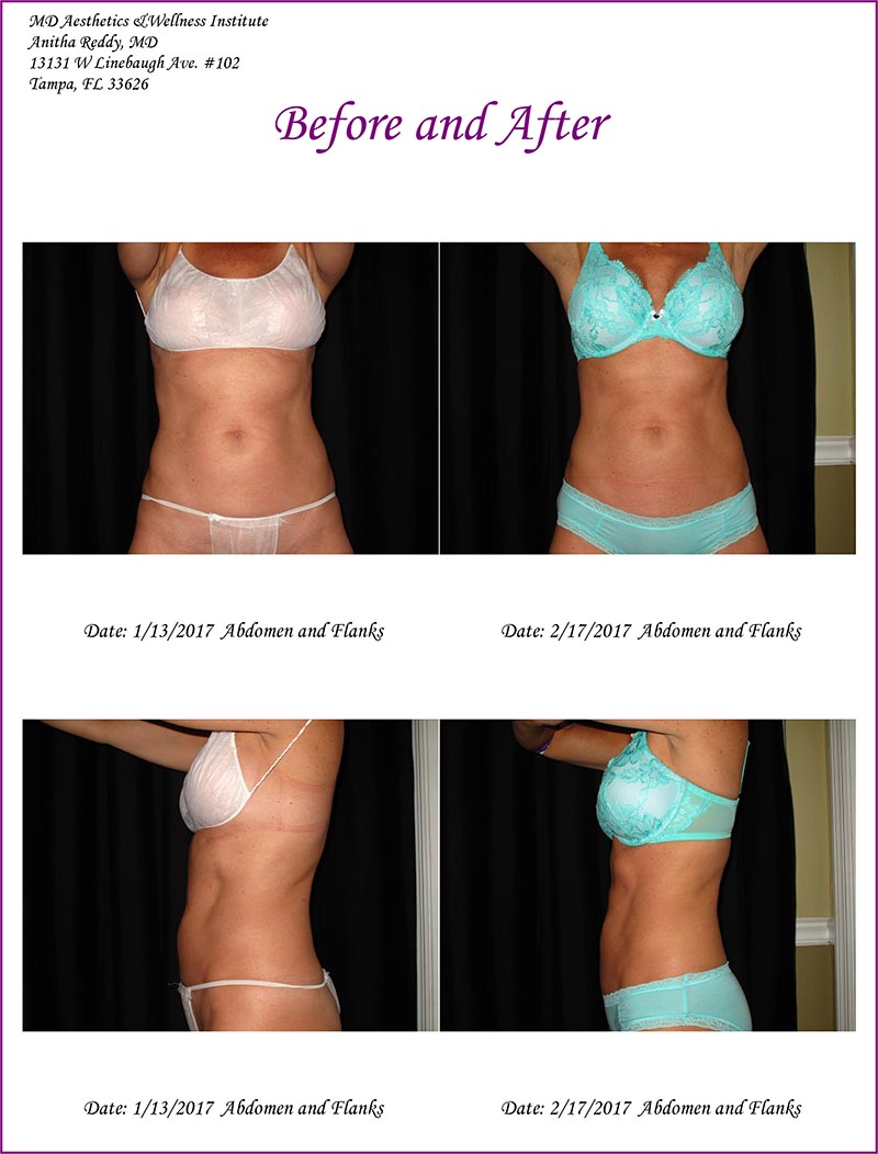 Coolsculpting Before and After Treatment Photo 9