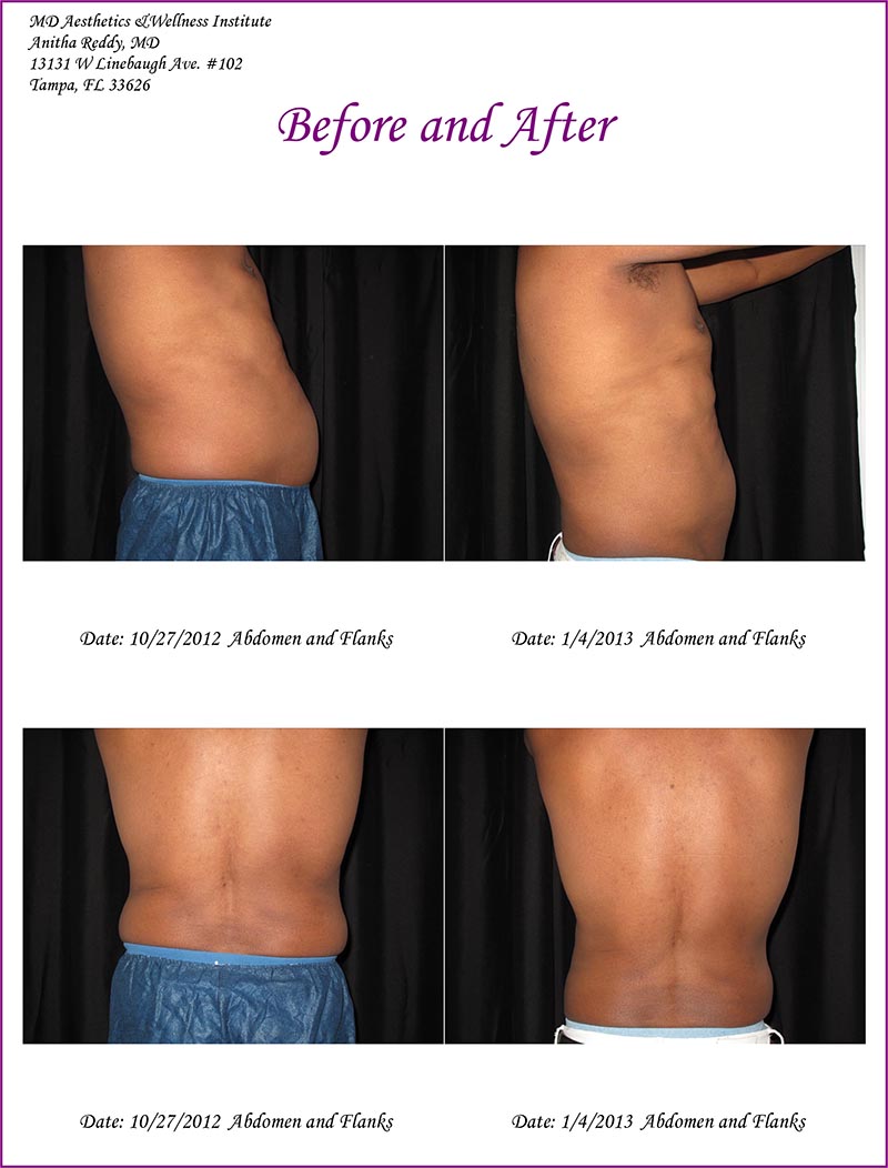 Coolsculpting Before and After Treatment Photo 11