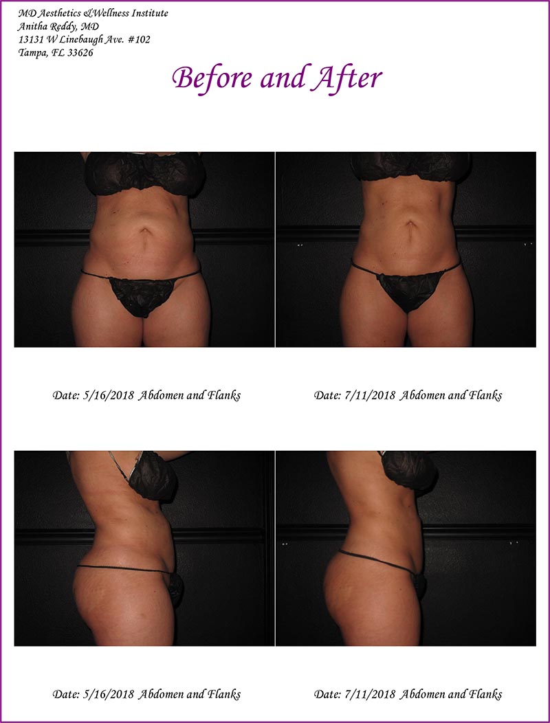 Coolsculpting Before and After Treatment Photo 12