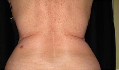 CoolSculpting Results Tampa