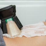 Coolsculpting Treatment Procedure